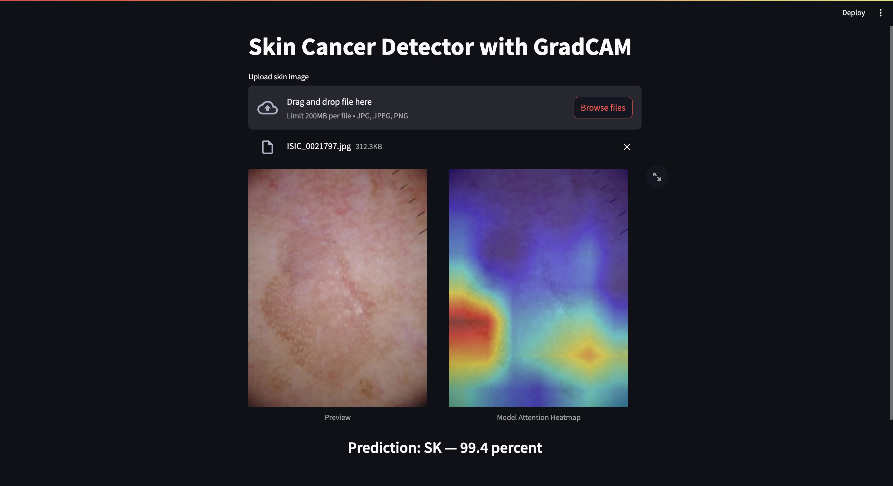 Skin Cancer Classification
